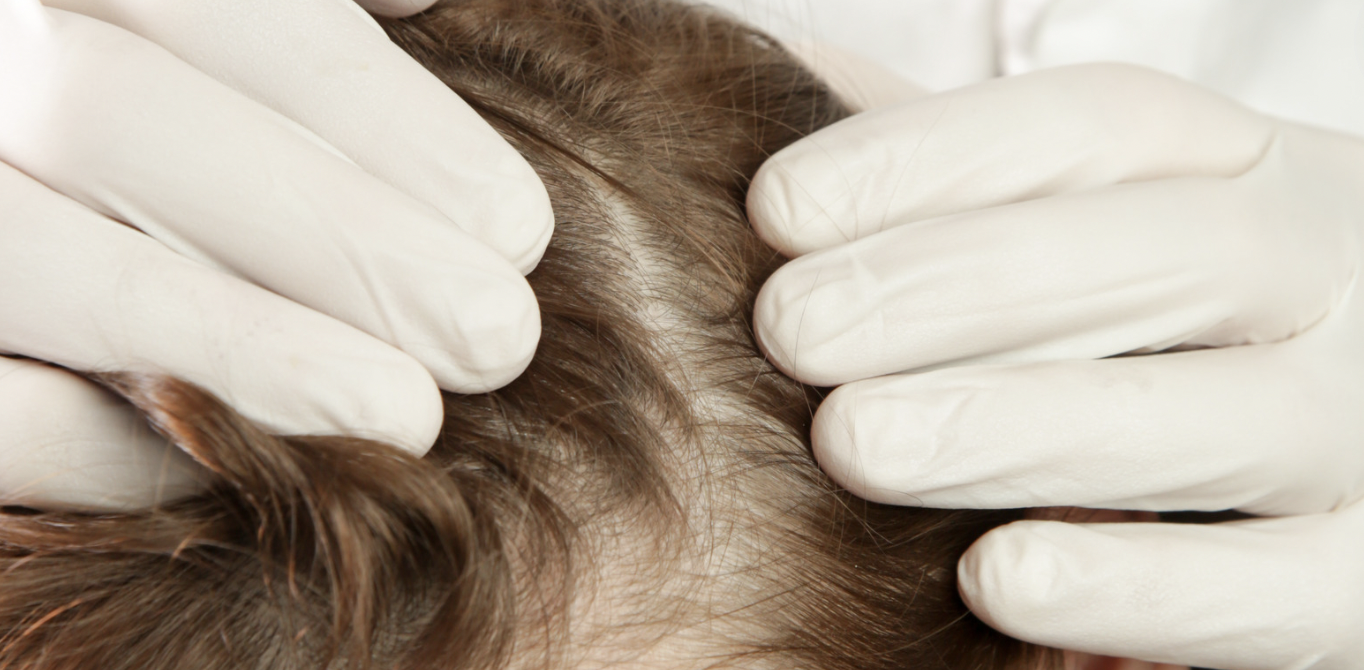 Hair Loss Specialist Near College Park